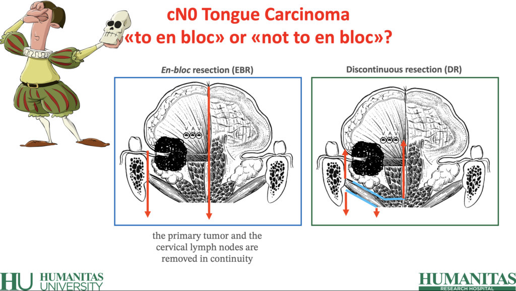 Giuseppe Mercante Otorinolaringoiatra Bari Parma Milano Humanitas Tongue Cancer - Compartmental Surgery - Lingua